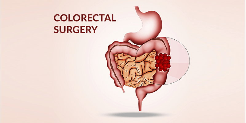 Colon Rectal Surgery with Dr. Debashish Das, the best Laparoscopic, Endoscopic & General Surgeon in Chembur, Mumbai.