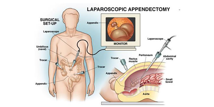 Laproscopic Appendicectomy with Dr. Debashish Das, the best Laparoscopic, Endoscopic & General Surgeon in Chembur, Mumbai.