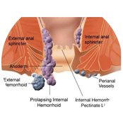 Piles Surgery with Dr. Debashish Das is one of the best Laparoscopic, Endoscopic & General Surgeon in Chembur, Mumbai.