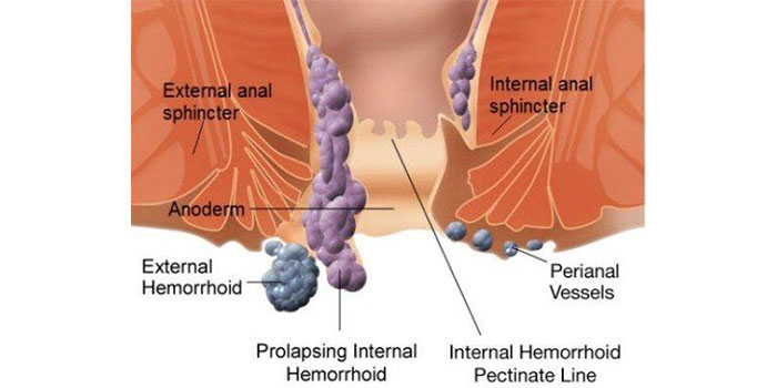 Haemorrhoids (piles) surgery with Dr. Debashish Das is one of the best Laparoscopic, Endoscopic & General Surgeon in Chembur, Mumbai.